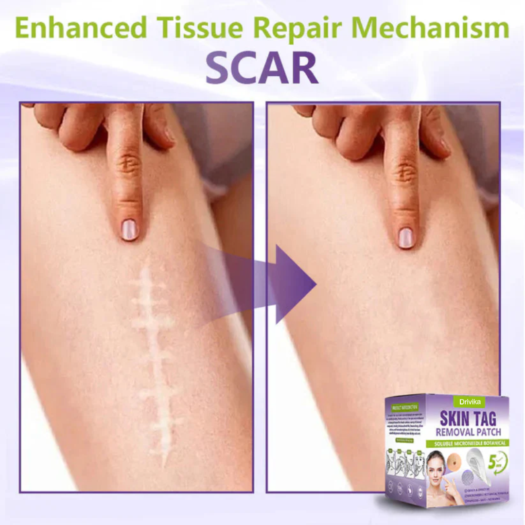Drivika® Soluble Microneedle Botanical Skin Tag Removal Patch