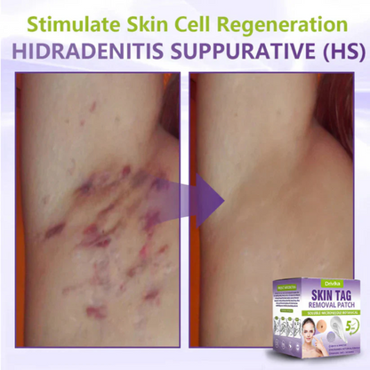 Drivika® Soluble Microneedle Botanical Skin Tag Removal Patch