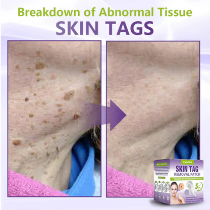 Drivika® Soluble Microneedle Botanical Skin Tag Removal Patch