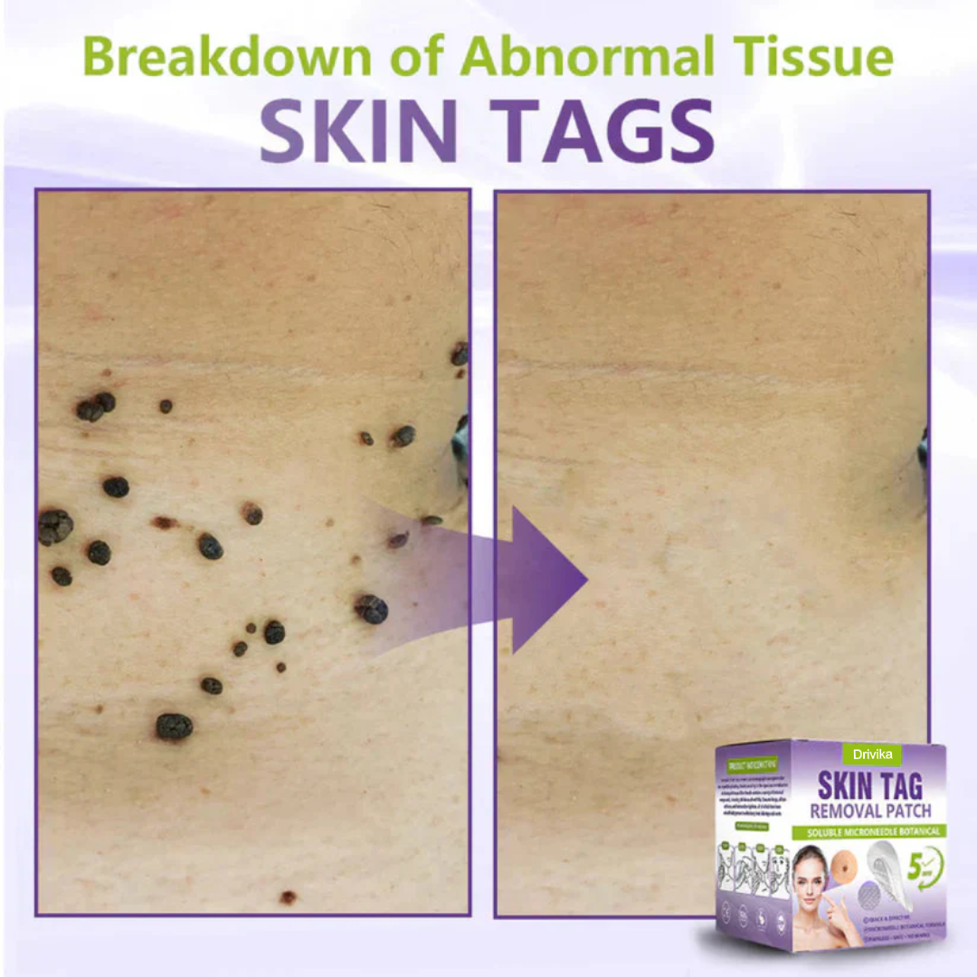Drivika® Soluble Microneedle Botanical Skin Tag Removal Patch