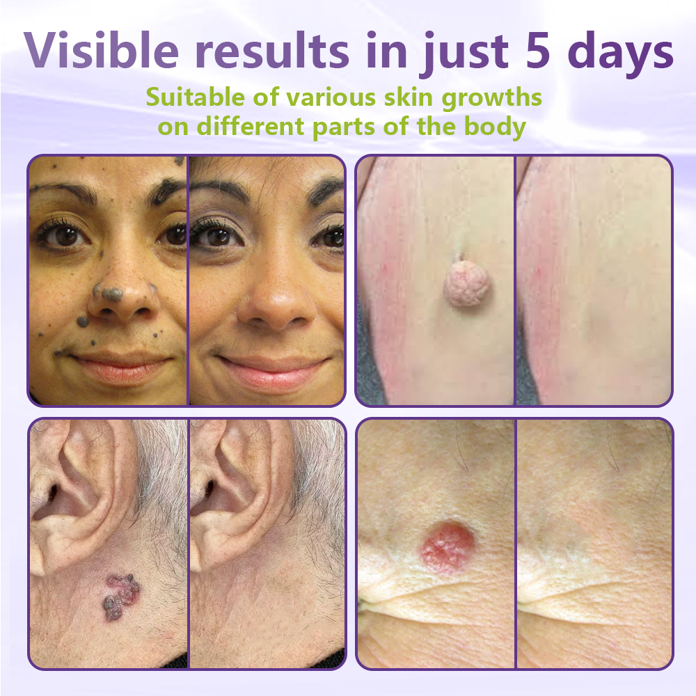 Drivika® Soluble Microneedle Botanical Skin Tag Removal Patch